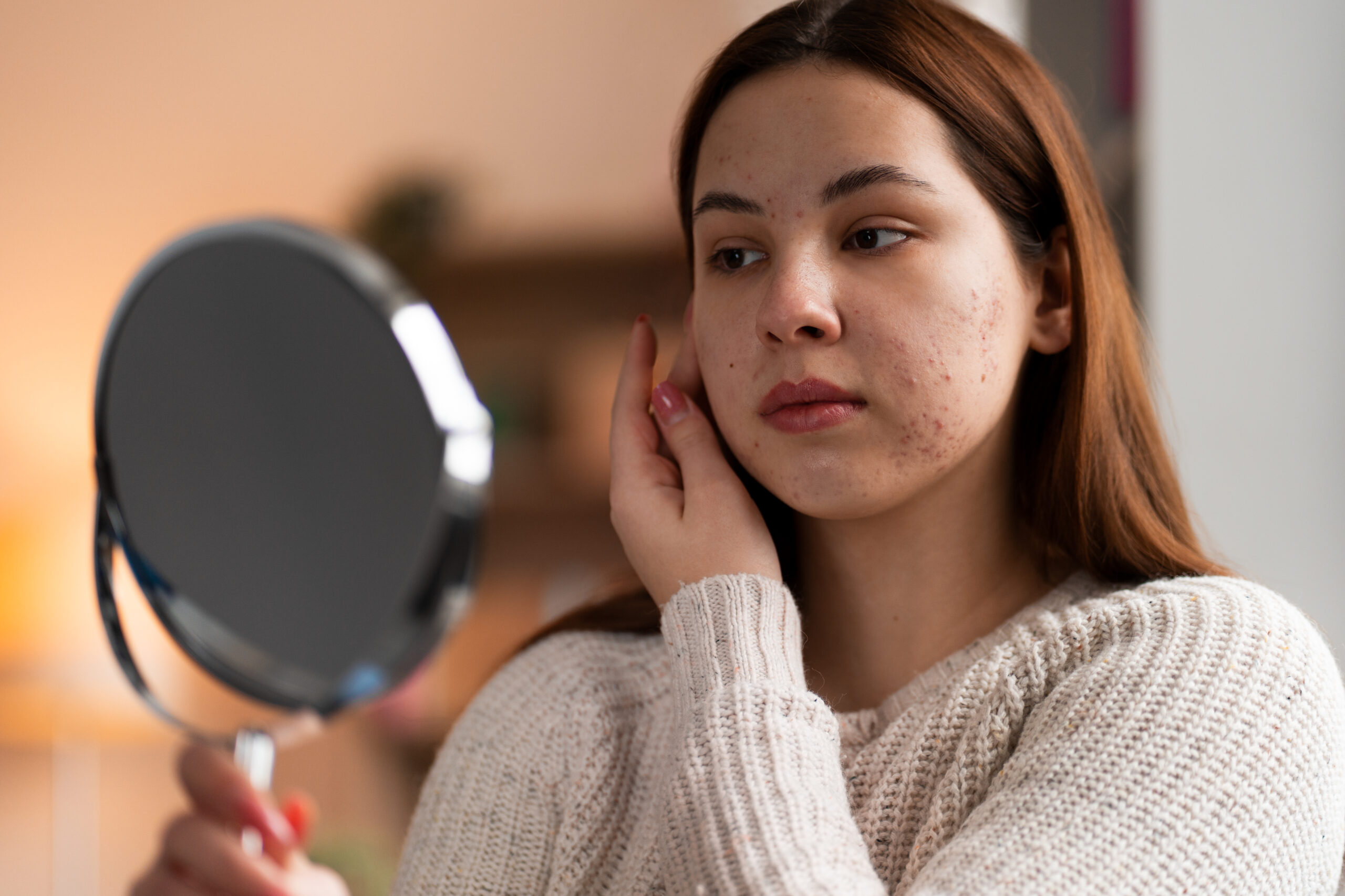 Hormonal Acne: Causes and Treatment
